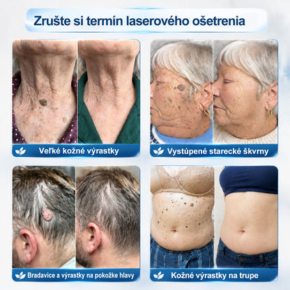 𝐎𝐟𝐢𝐜𝐢𝐚𝐥𝐧𝐲 𝐨𝐛𝐜𝐡𝐨𝐝 𝐦𝐚𝐫𝐤𝐲 | ✅️👩‍⚕️𝐏i𝐜𝐝o® 7dni Prípravok na odstránenie kožných výrastkov a pigmentových škvŕn (bezbolestný roll-on aplikátor bez jaziev) 🙏