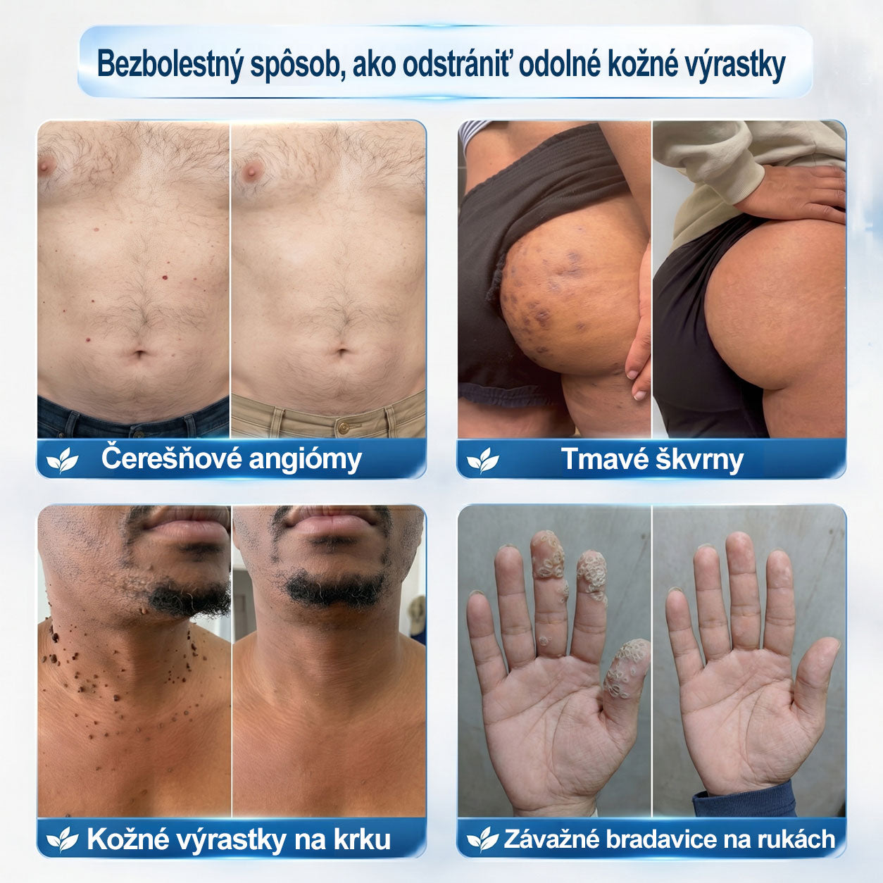 𝐎𝐟𝐢𝐜𝐢𝐚𝐥𝐧𝐲 𝐨𝐛𝐜𝐡𝐨𝐝 𝐦𝐚𝐫𝐤𝐲 | ✅️👩‍⚕️𝐏i𝐜𝐝o® 7dni Prípravok na odstránenie kožných výrastkov a pigmentových škvŕn (bezbolestný roll-on aplikátor bez jaziev) 🙏