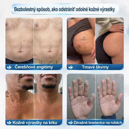 𝐎𝐟𝐢𝐜𝐢𝐚𝐥𝐧𝐲 𝐨𝐛𝐜𝐡𝐨𝐝 𝐦𝐚𝐫𝐤𝐲 | ✅️👩‍⚕️𝐏i𝐜𝐝o® 7dni Prípravok na odstránenie kožných výrastkov a pigmentových škvŕn (bezbolestný roll-on aplikátor bez jaziev) 🙏