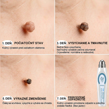 𝐎𝐟𝐢𝐜𝐢𝐚𝐥𝐧𝐲 𝐨𝐛𝐜𝐡𝐨𝐝 𝐦𝐚𝐫𝐤𝐲 | ✅️👩‍⚕️𝐏i𝐜𝐝o® 7dni Prípravok na odstránenie kožných výrastkov a pigmentových škvŕn (bezbolestný roll-on aplikátor bez jaziev) 🙏