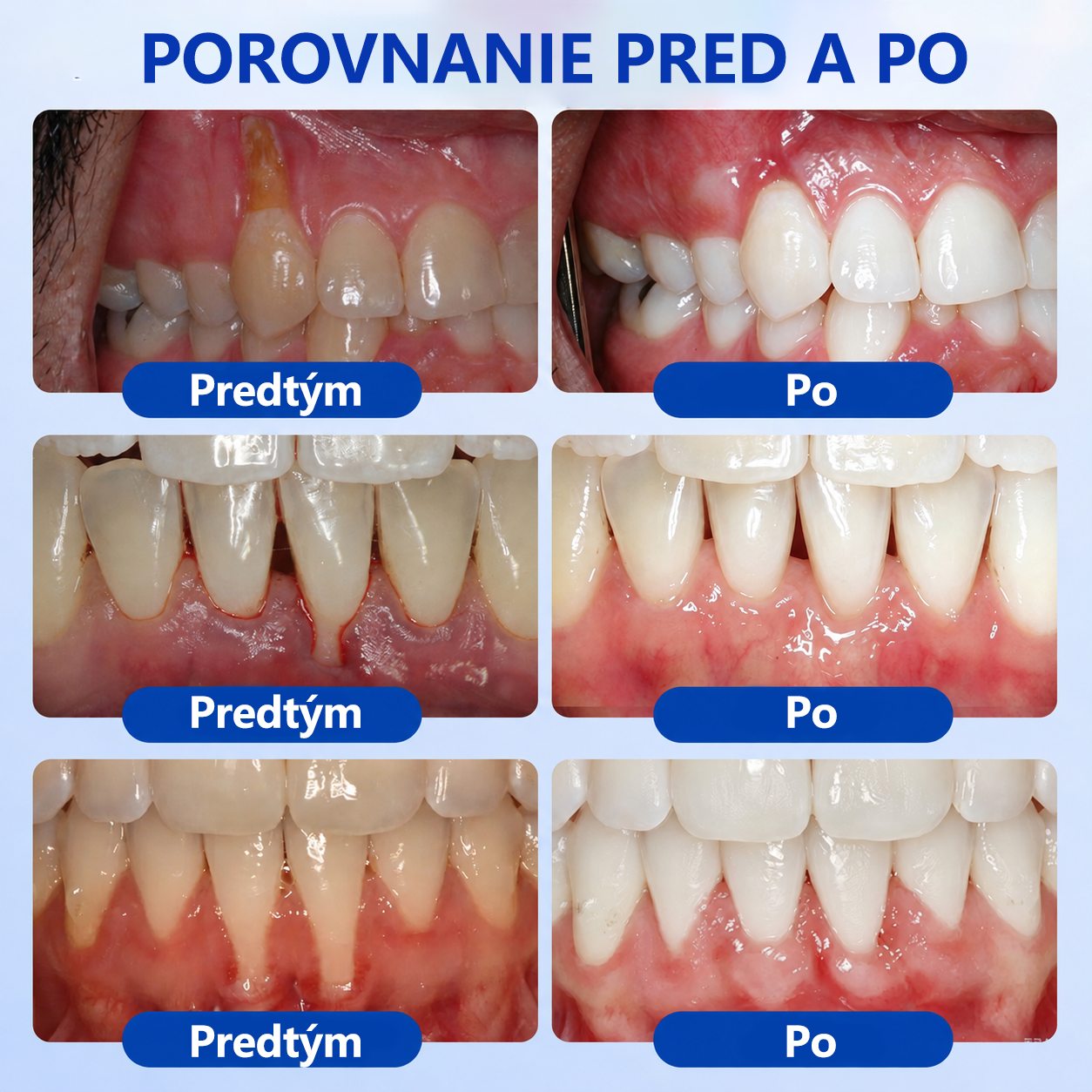 🇪🇺🏅🦷🛡️Evolvion® GumRevive Gél na periodontálnu opravu